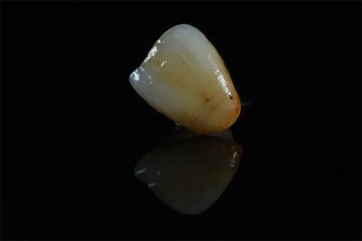 Premium Zirconia Crowns with Natural-Looking Stain - China Dental Manufacturer