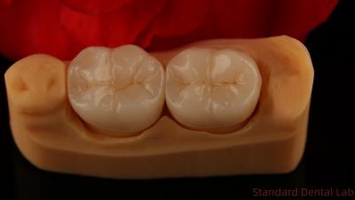 Full Contour Zirconia Crown Exceptional Strength and Esthetics No Porcelian Overlay Posterior Crown China Dental Lab