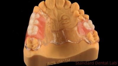 Flexible Clear Metal Cast Framework Partial Dentures High Esthetics Perfect Fit