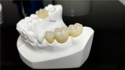 Ceramic Dental Crown,Zirconia Dental Crowns